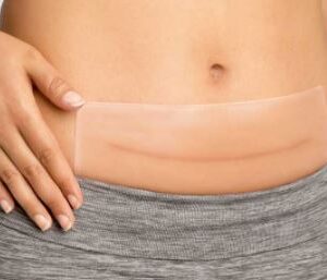 Silicone Patches for Scars - In Different Shapes Sizes - 2 Pieces Per Pack
