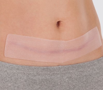 Silicone Scar Pad - 100% Medical Grade Silicone Patches for Scar Therapy in Variety of Sizes - Image 3
