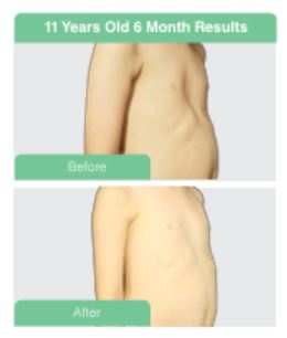 Pectus Excavatum Before and After